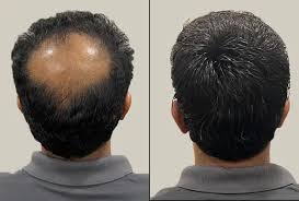 Everyday Confidence: Regular Hair Patch